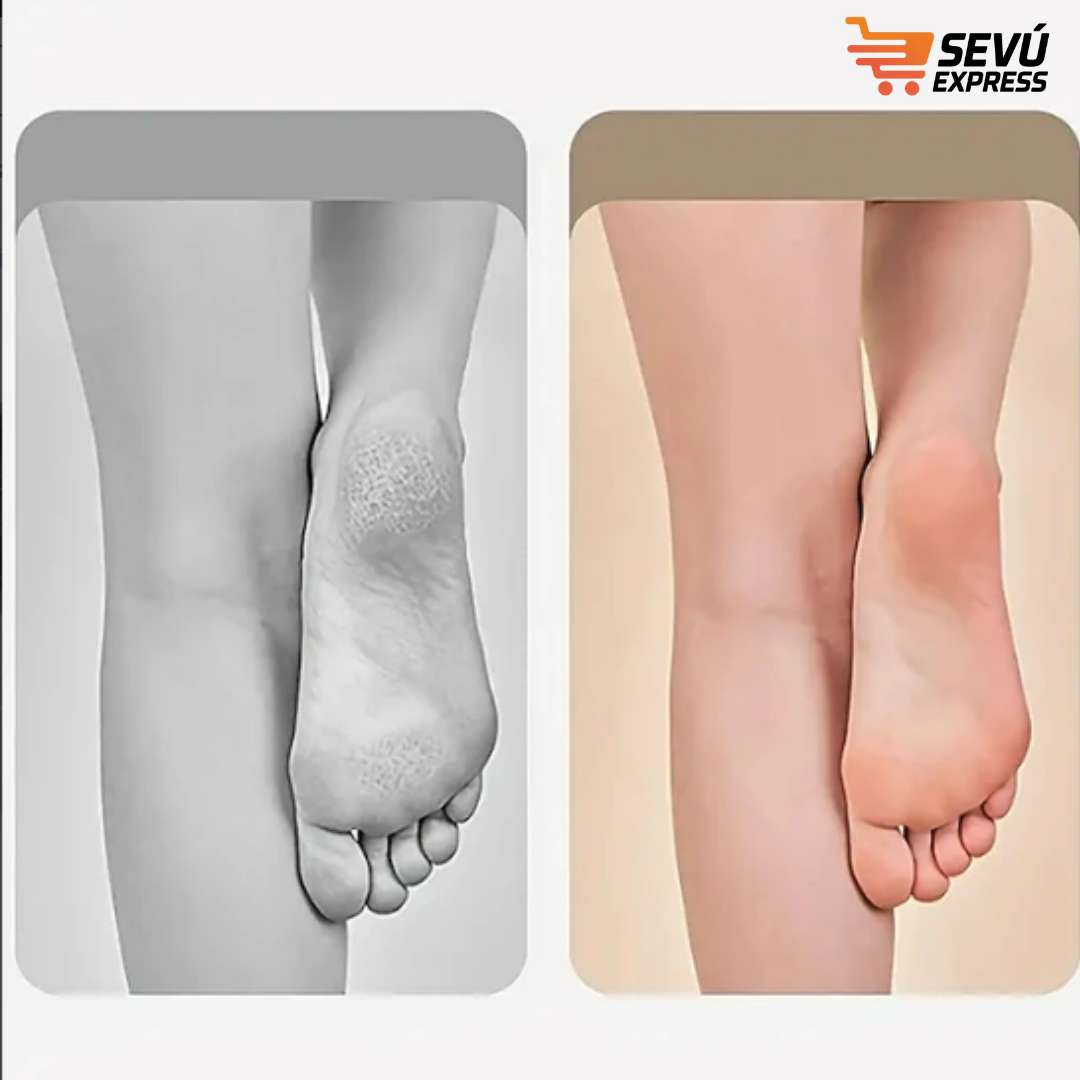 Removedor de callos – Talones Suaves sin Dolor